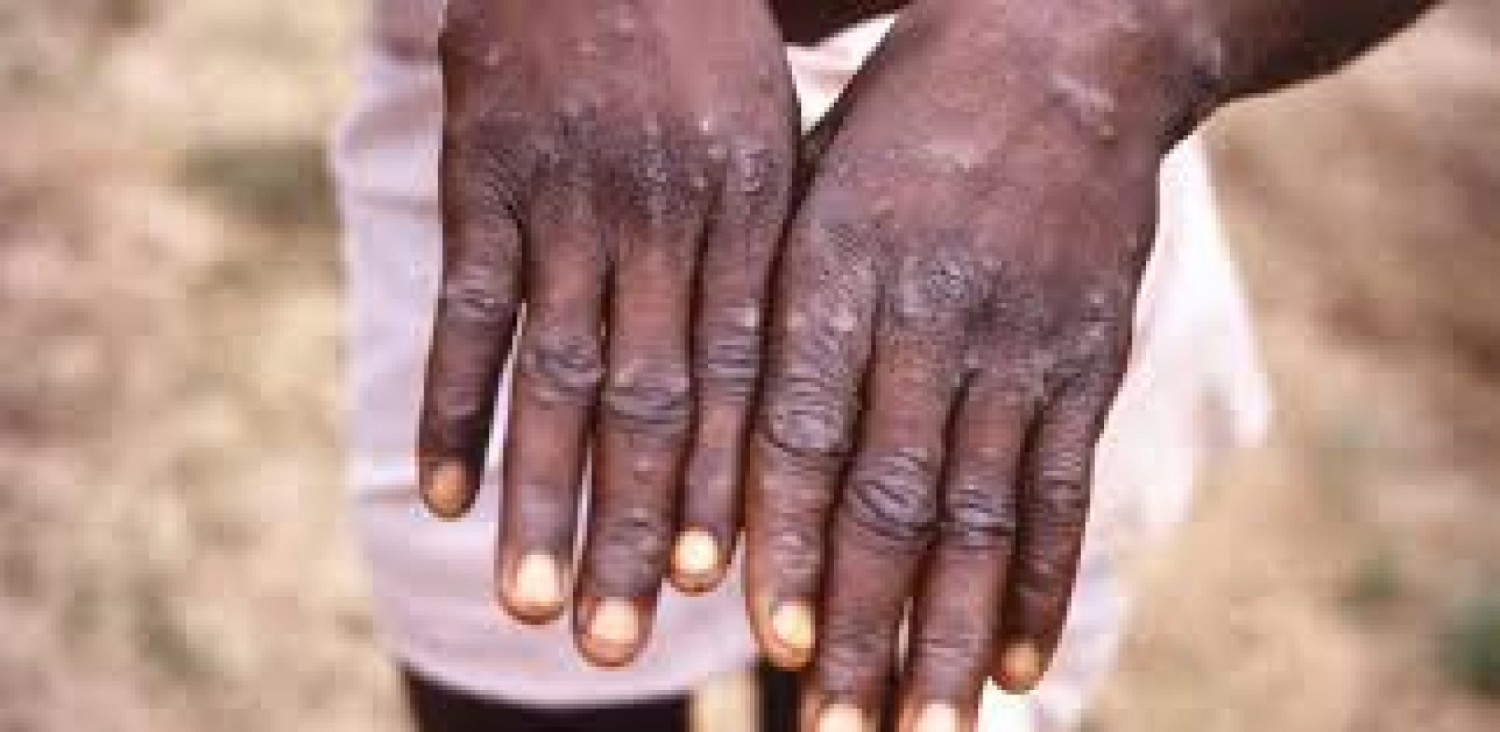 RDC : La variole du singe ou « Monkeypox » fait des ravages, 450 décès enregistrés