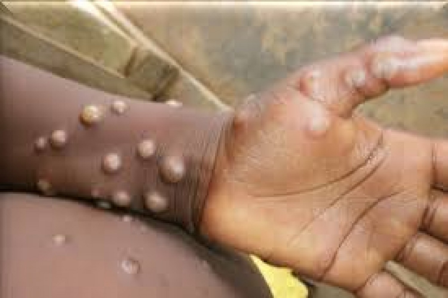 Congo : 21 cas de mpox confirmés, rien d'alarmant selon le ministre de la santé